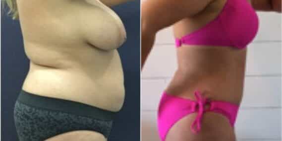 mommy makeover colombia 271-4-min