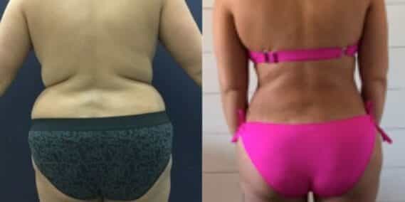 mommy makeover colombia 271-5-min