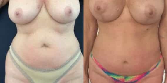 mommy makeover colombia 274-1-min