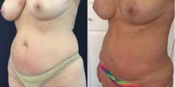 mommy makeover colombia 274-2-min