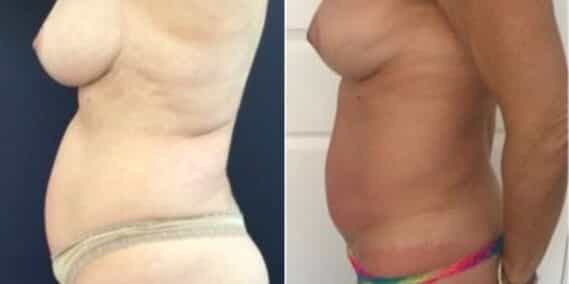 mommy makeover colombia 274-3-min