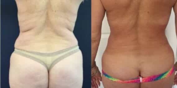 mommy makeover colombia 274-4-min
