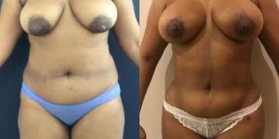 mommy makeover colombia 279-1-min