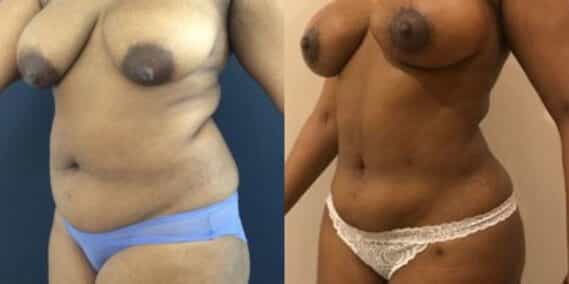 mommy makeover colombia 279-2-min