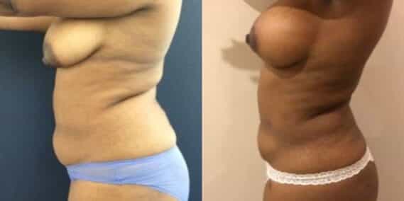 mommy makeover colombia 279-3-min