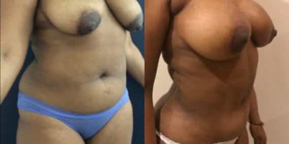 mommy makeover colombia 279-4-min