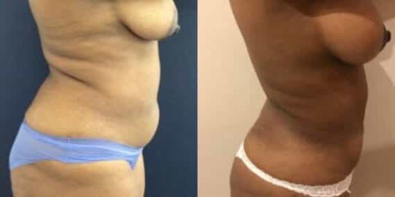 mommy makeover colombia 279-5-min