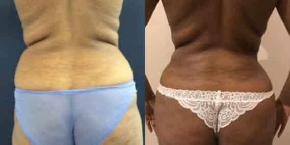 mommy makeover colombia 279-6-min