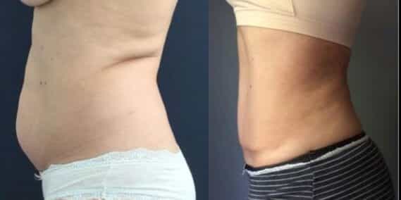mommy makeover colombia 284-3-min