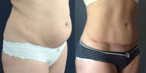 mommy makeover colombia 284-4-min