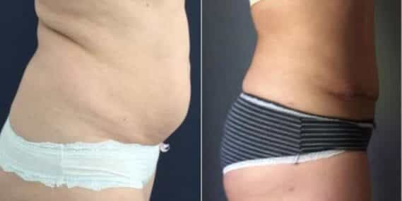mommy makeover colombia 284-5-min