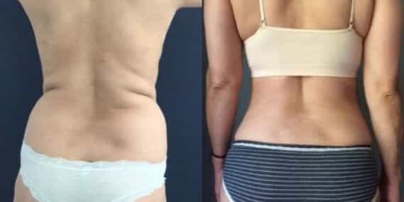 mommy makeover colombia 284-6-min