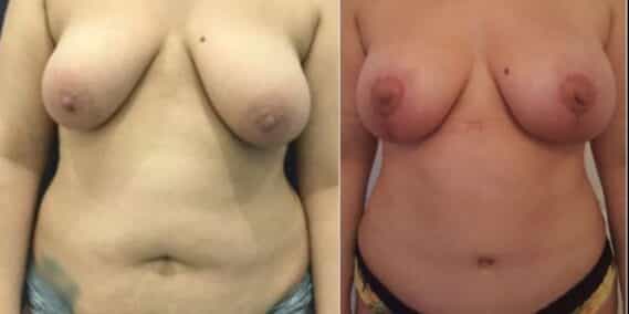 mommy makeover colombia 288-1-min