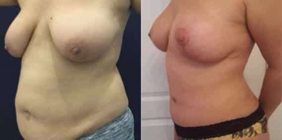 mommy makeover colombia 288-2-min