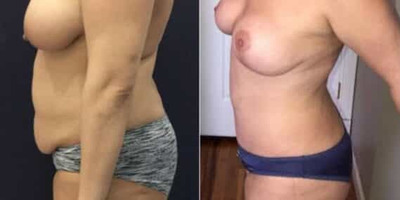 mommy makeover colombia 288-3-min