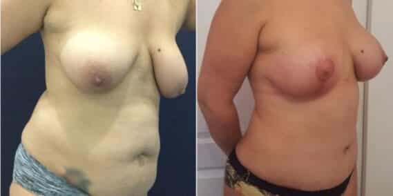 mommy makeover colombia 288-4-min