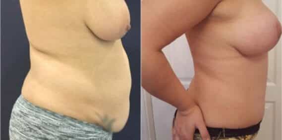 mommy makeover colombia 288-5-min