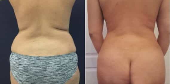 mommy makeover colombia 288-6-min