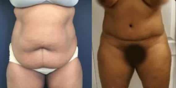 mommy makeover colombia 289-1-min