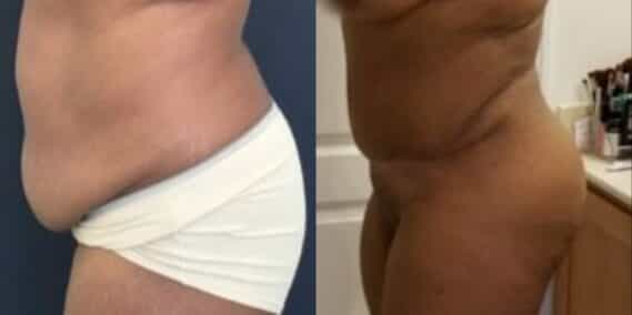 mommy makeover colombia 289-2-min
