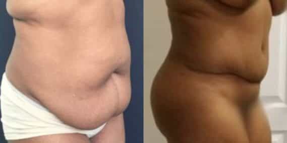 mommy makeover colombia 289-3-min