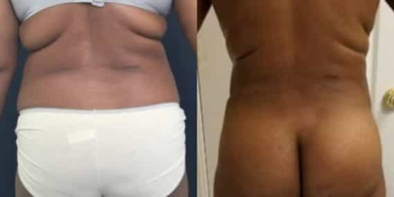 mommy makeover colombia 289-4-min
