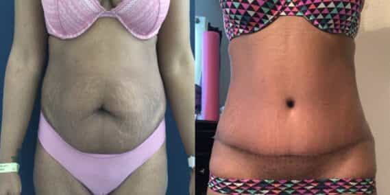 mommy makeover colombia 290-1-min