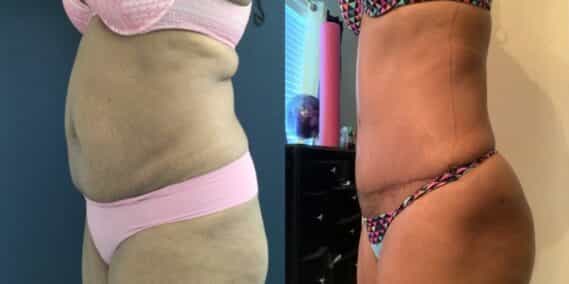 mommy makeover colombia 290-2-min