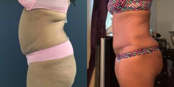 mommy makeover colombia 290-3-min