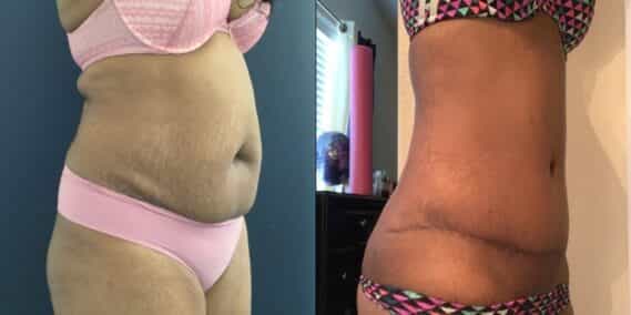 mommy makeover colombia 290-4-min