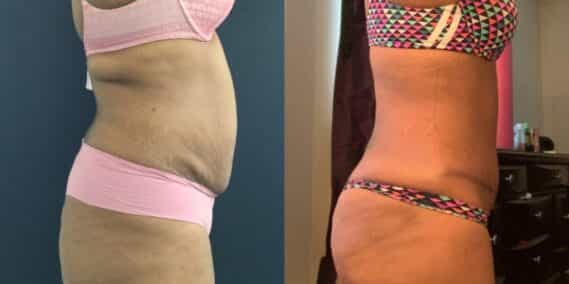 mommy makeover colombia 290-5-min