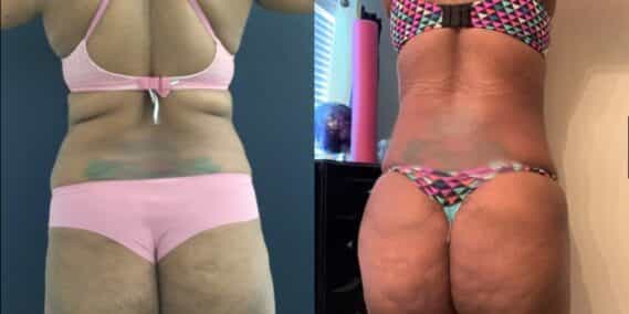 mommy makeover colombia 290-6-min