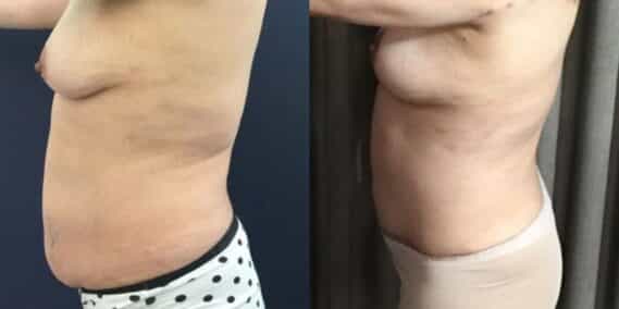 mommy makeover colombia 293-2-min