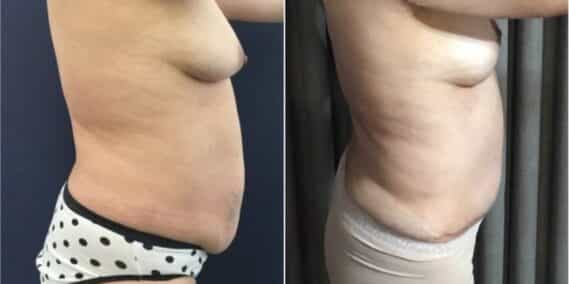 mommy makeover colombia 293-3-min