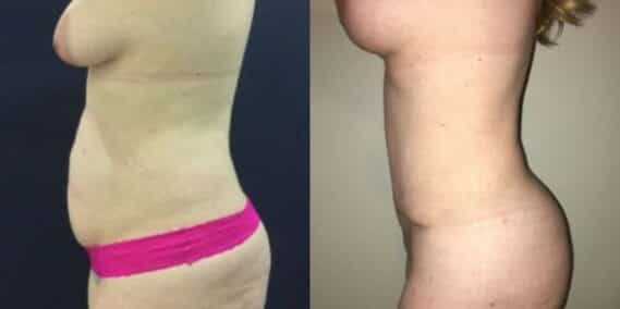 mommy makeover colombia 297-2-min