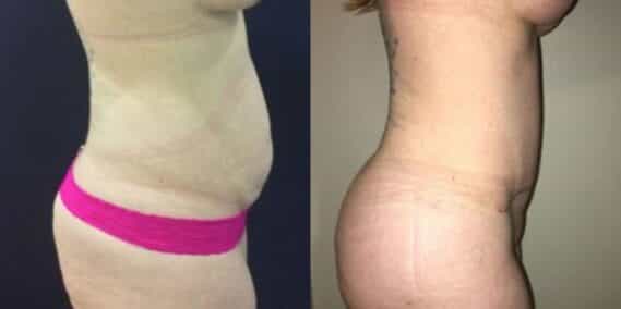 mommy makeover colombia 297-3 (1)-min
