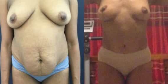 mommy makeover colombia 299-1-min