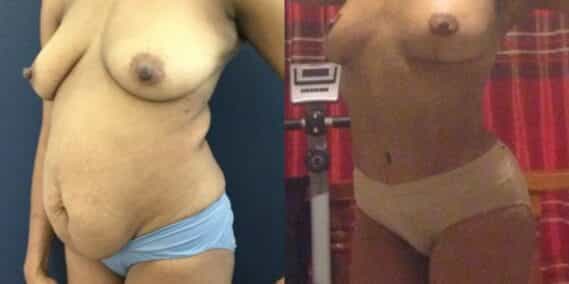 mommy makeover colombia 299-2-min