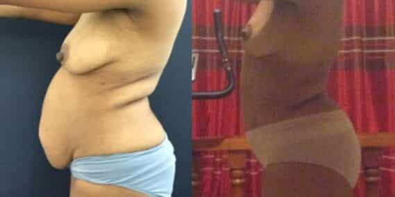 mommy makeover colombia 299-3-min