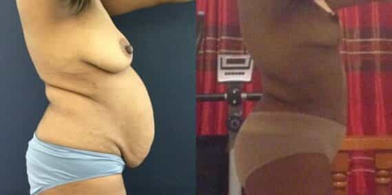 mommy makeover colombia 299-5-min