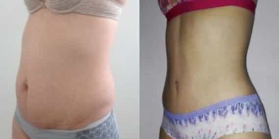 mommy makeover colombia 302-2-min