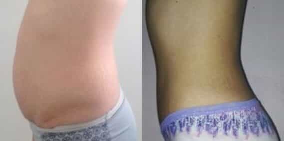 mommy makeover colombia 302-3-min