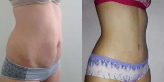 mommy makeover colombia 302-4-min
