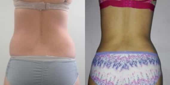 mommy makeover colombia 302-6-min