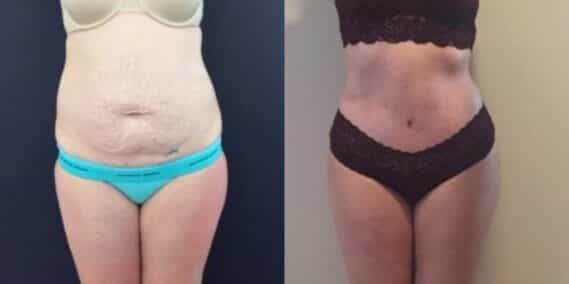 mommy makeover colombia 303-1-min