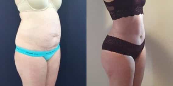 mommy makeover colombia 303-4-min