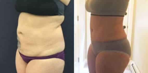 mommy makeover colombia 310-2-min