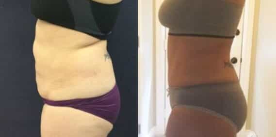 mommy makeover colombia 310-3-min