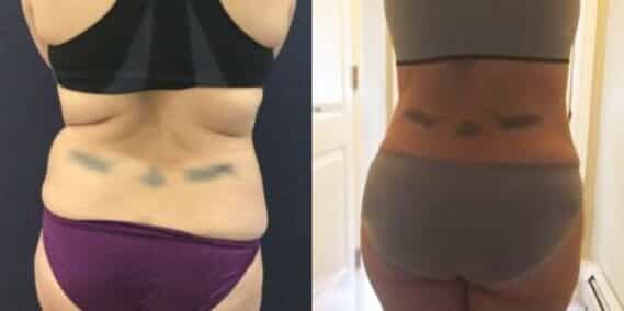 mommy makeover colombia 310-6-min