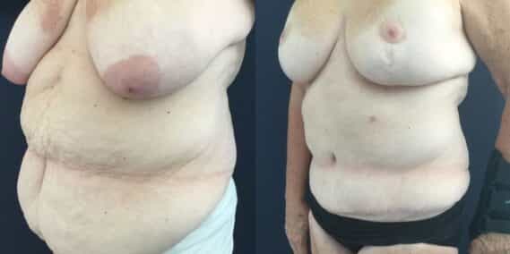 mommy makeover colombia 322-2-min